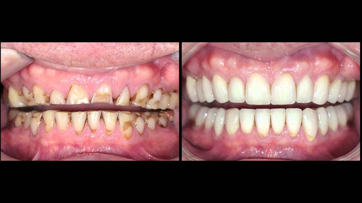 Full Mouth Rehabilitation 1