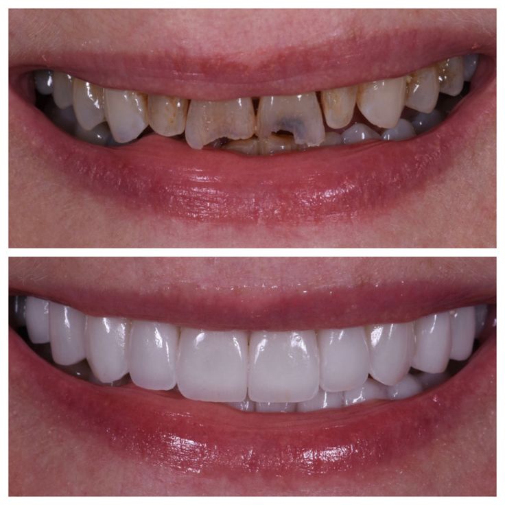 Full Mouth Rehabilitation 2