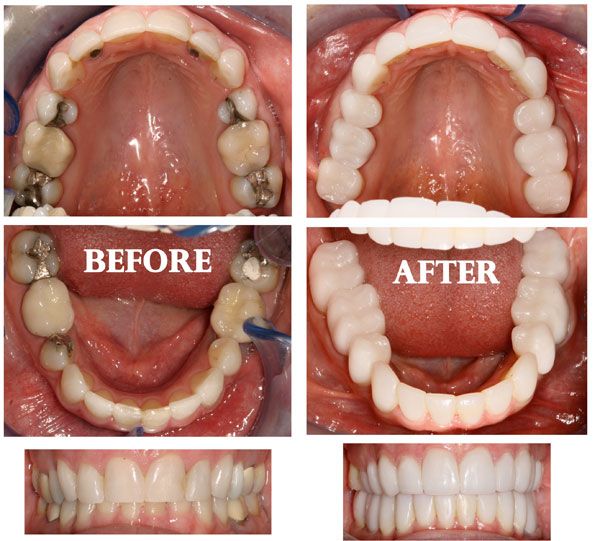 Full Mouth Rehabilitation 3