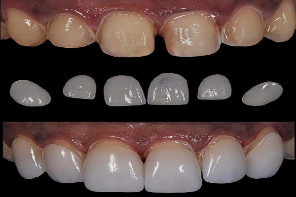 Smile Makeover
