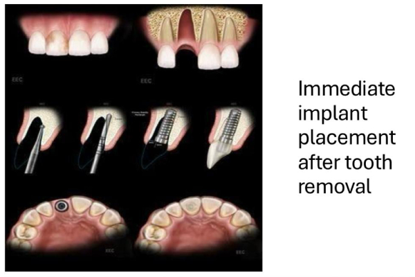 Teeth Cleaning 1