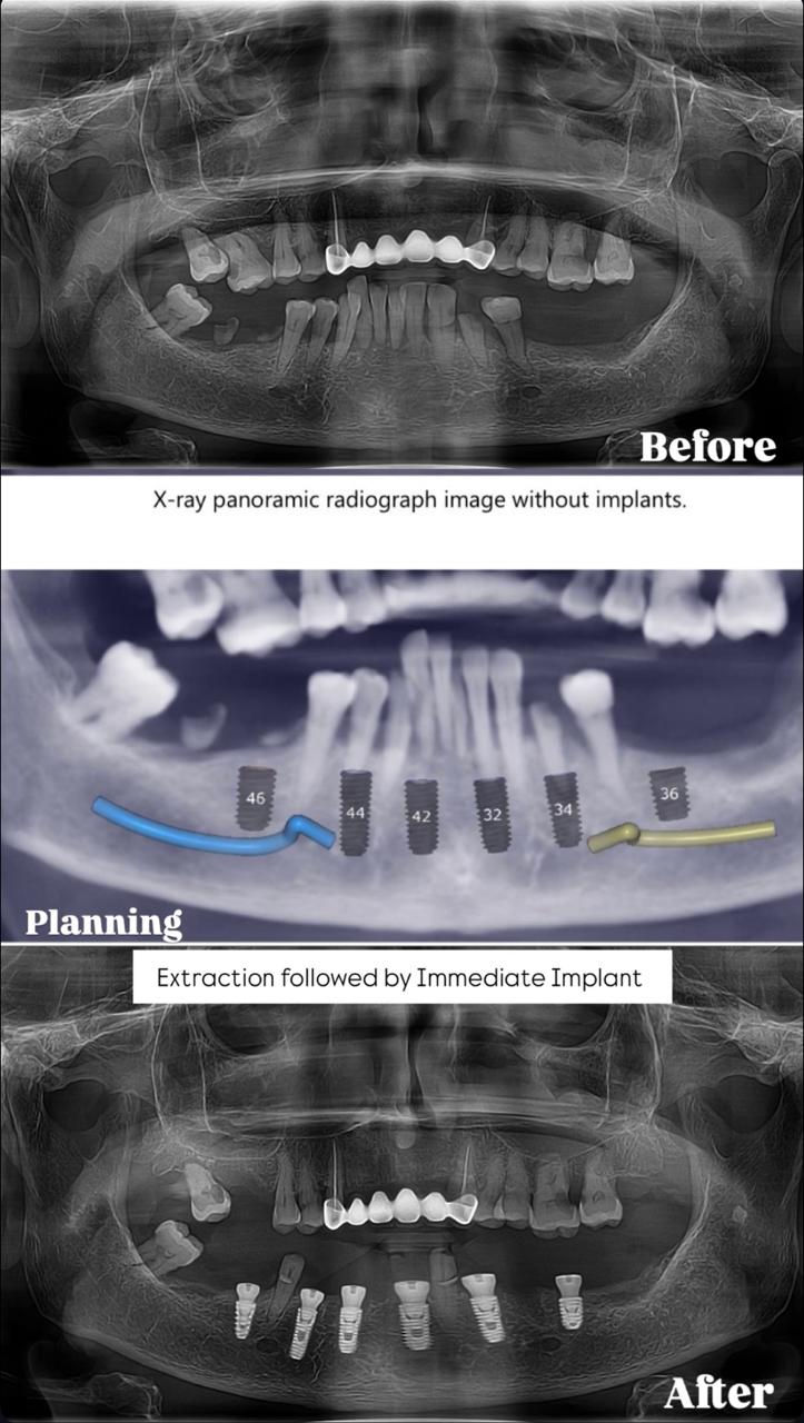 Teeth Cleaning 2