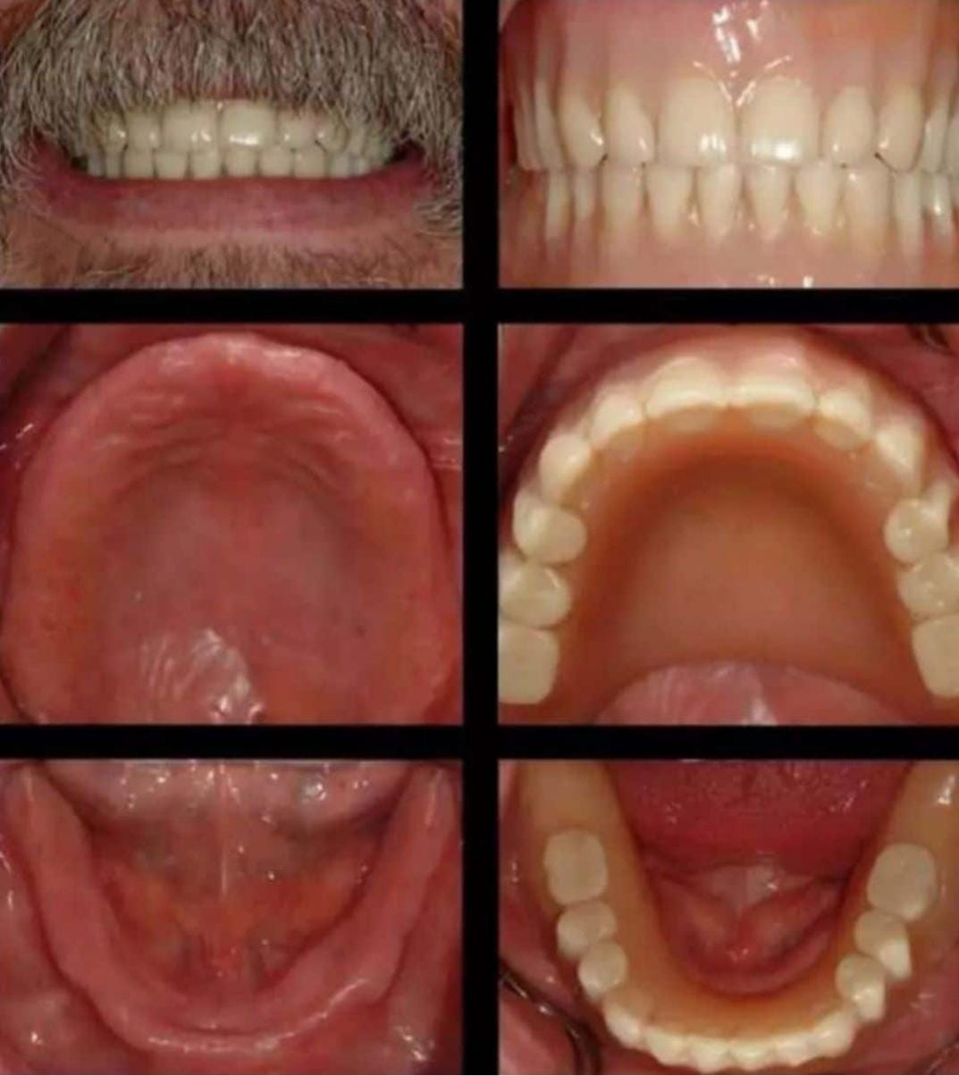 Complete Dentures