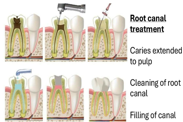 Root Canal Treatment