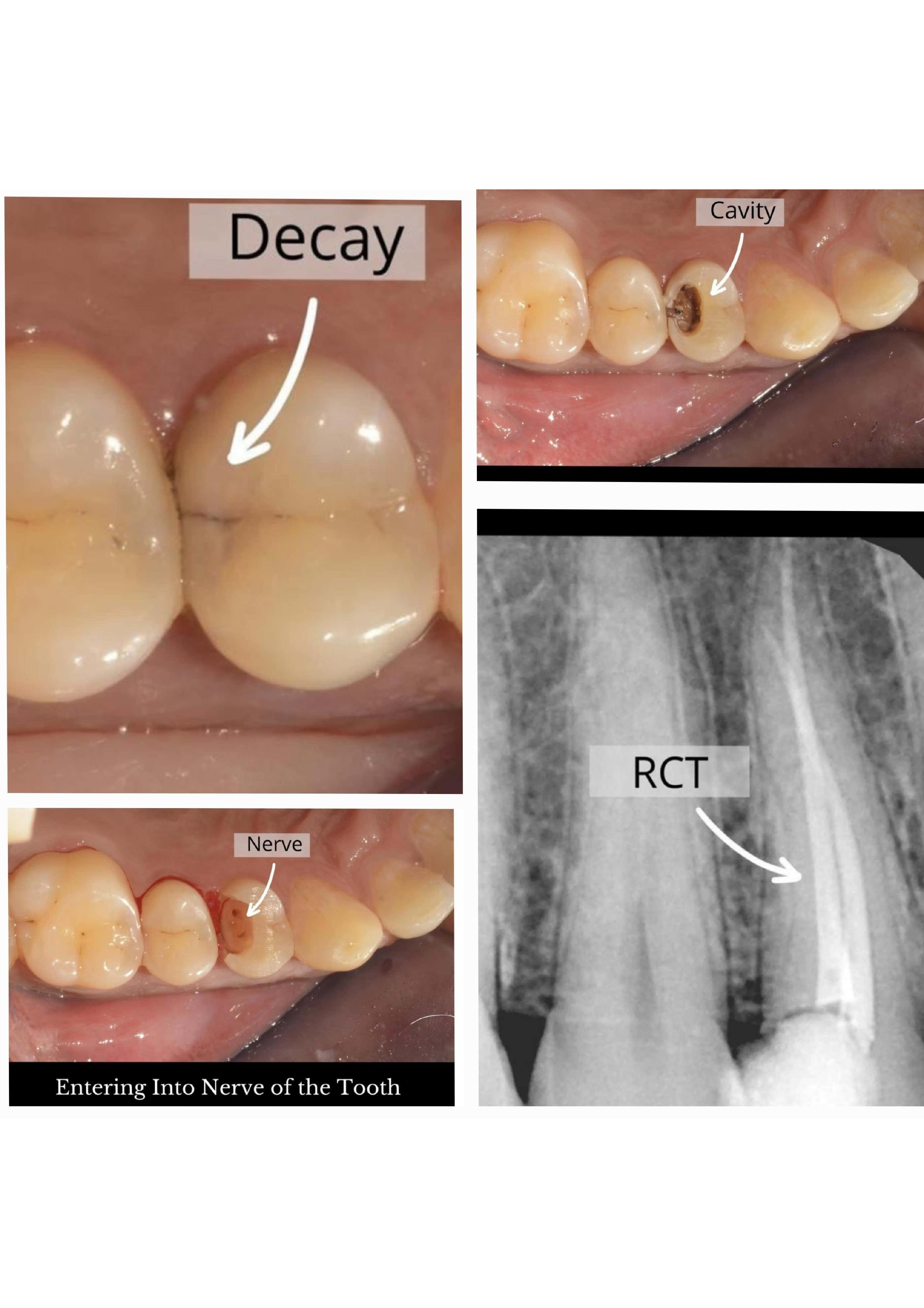 Root Canal Treatment 1