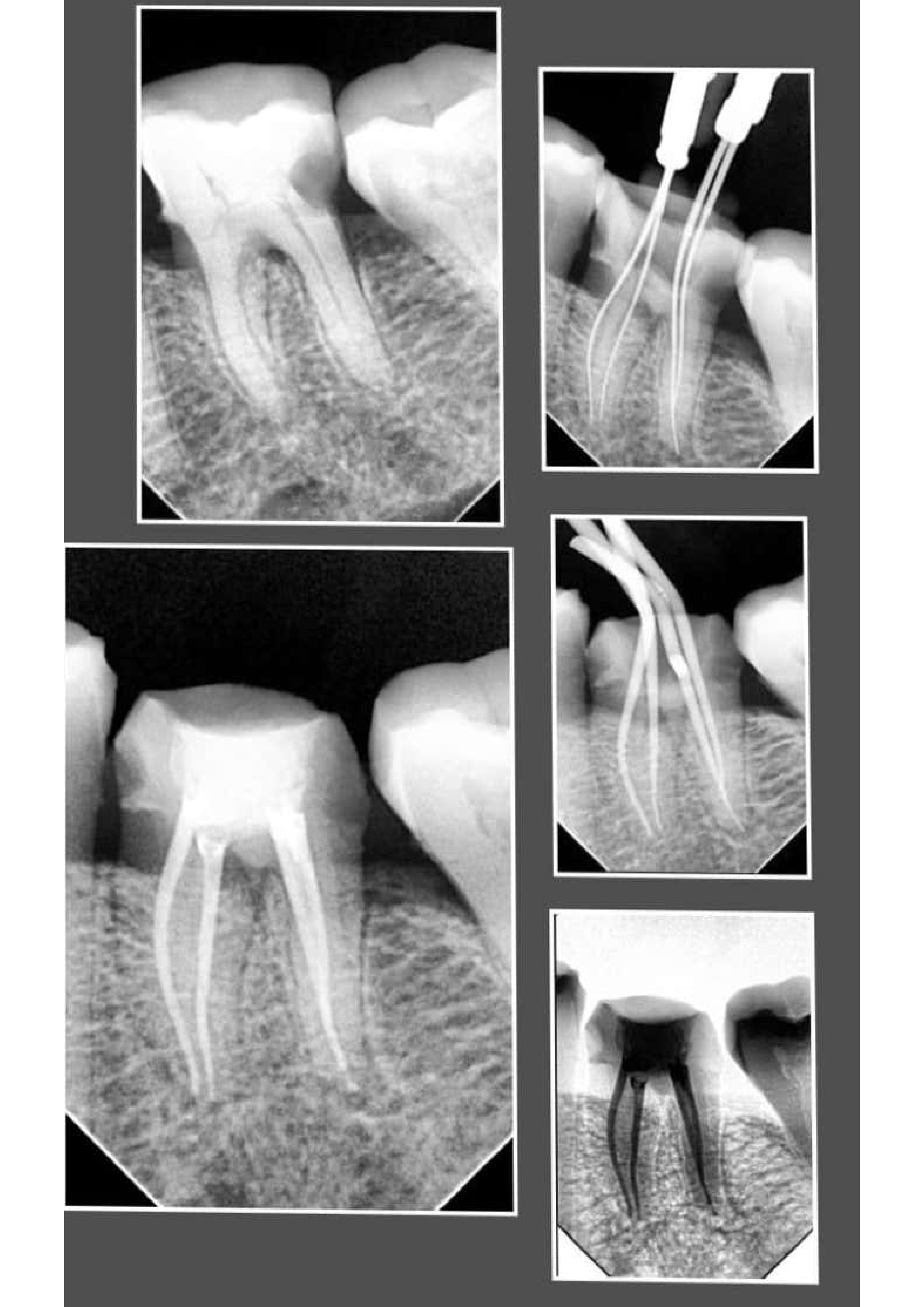 Root Canal Treatment 2