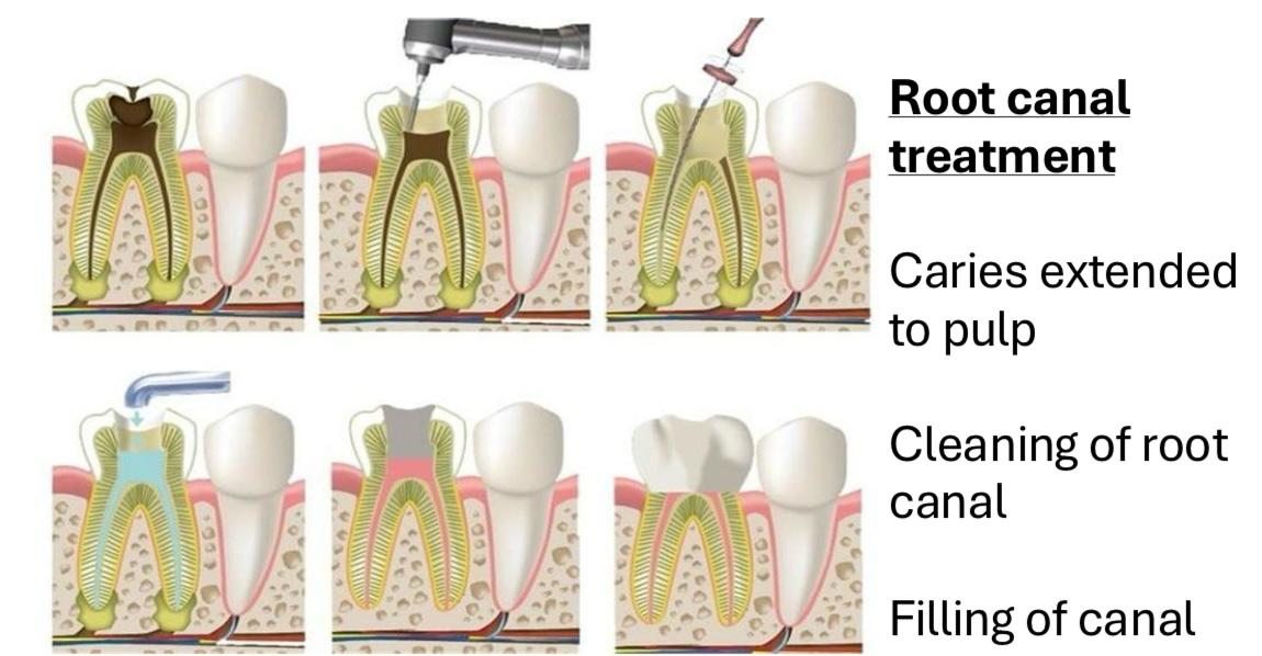 Root Canal Treatment 3