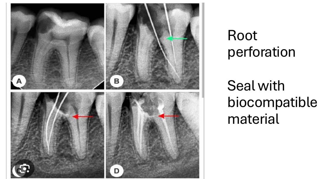 Root Canal Treatment 4