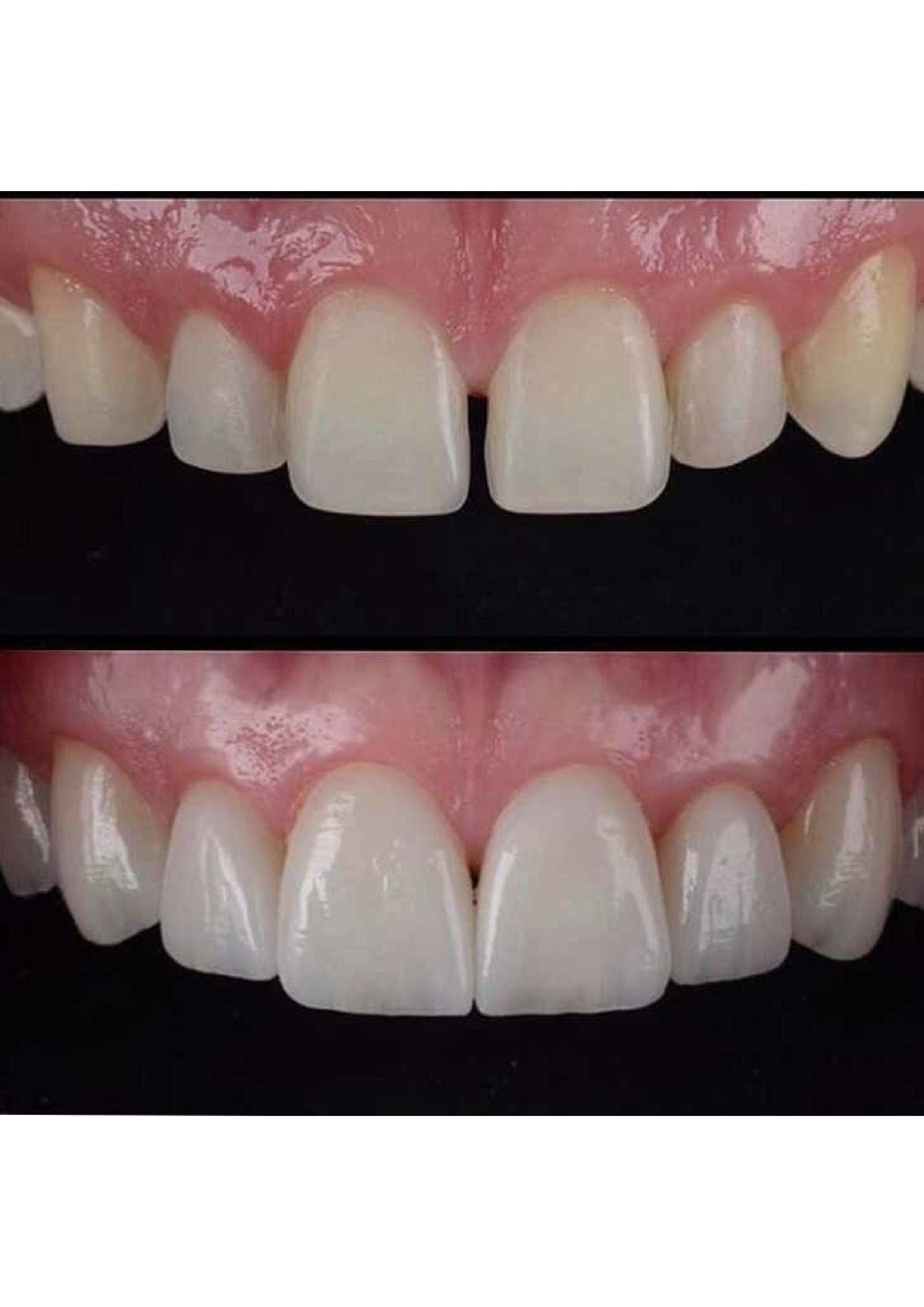 Smile Makeover 1