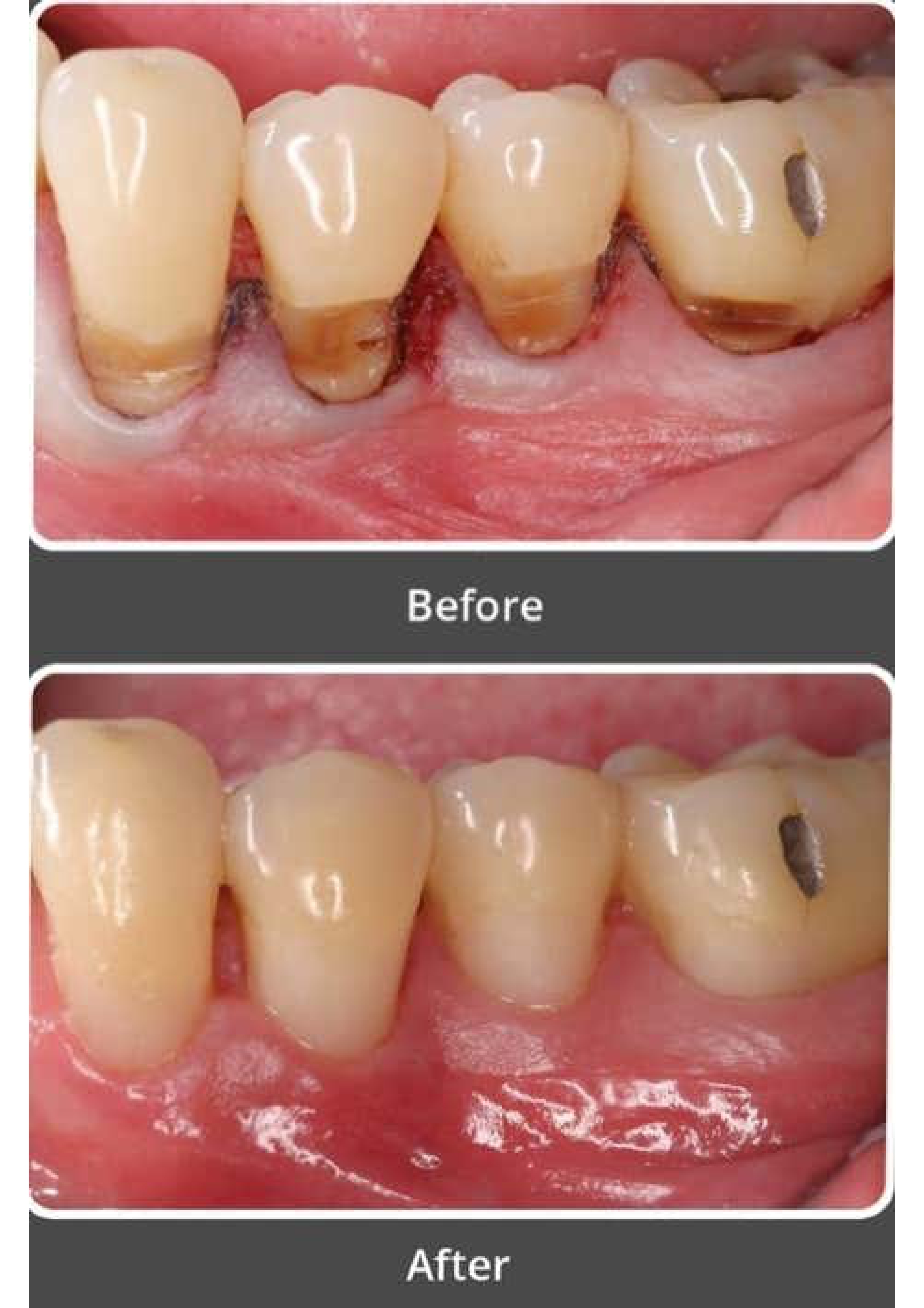 Tooth-Colored Filling 1