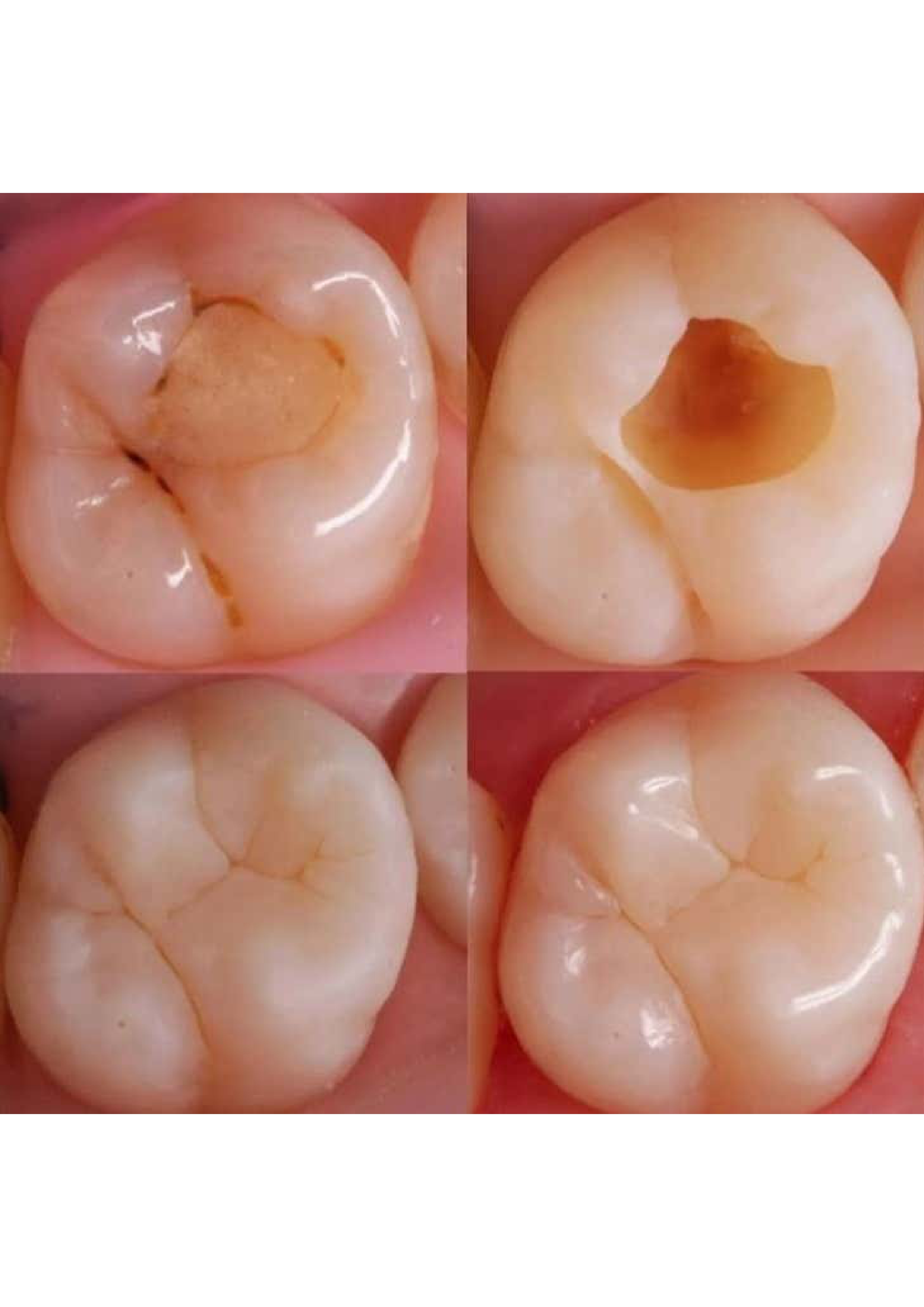 Tooth-Colored Filling 2