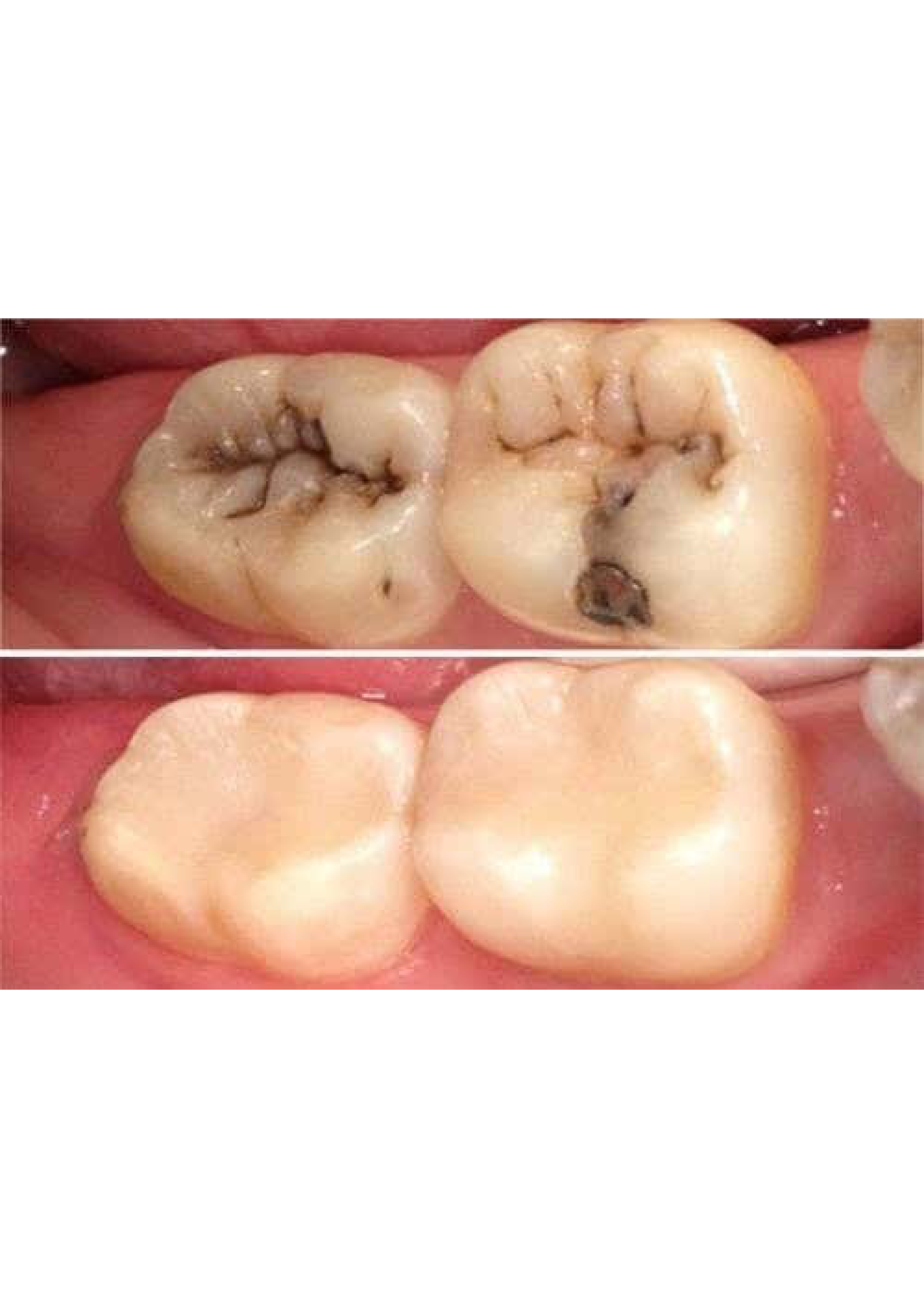 Tooth-Colored Filling 3