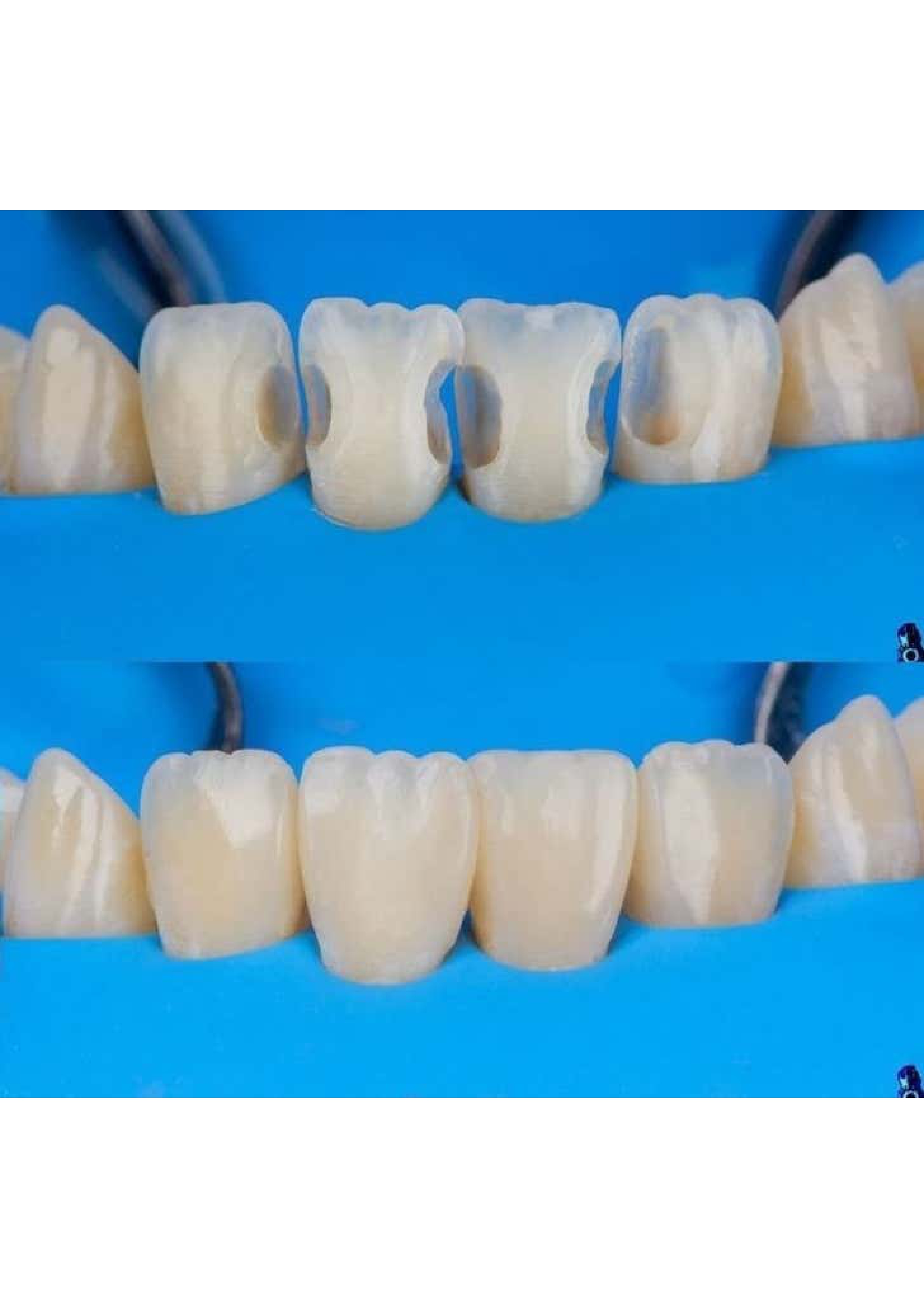 Tooth-Colored Filling 4