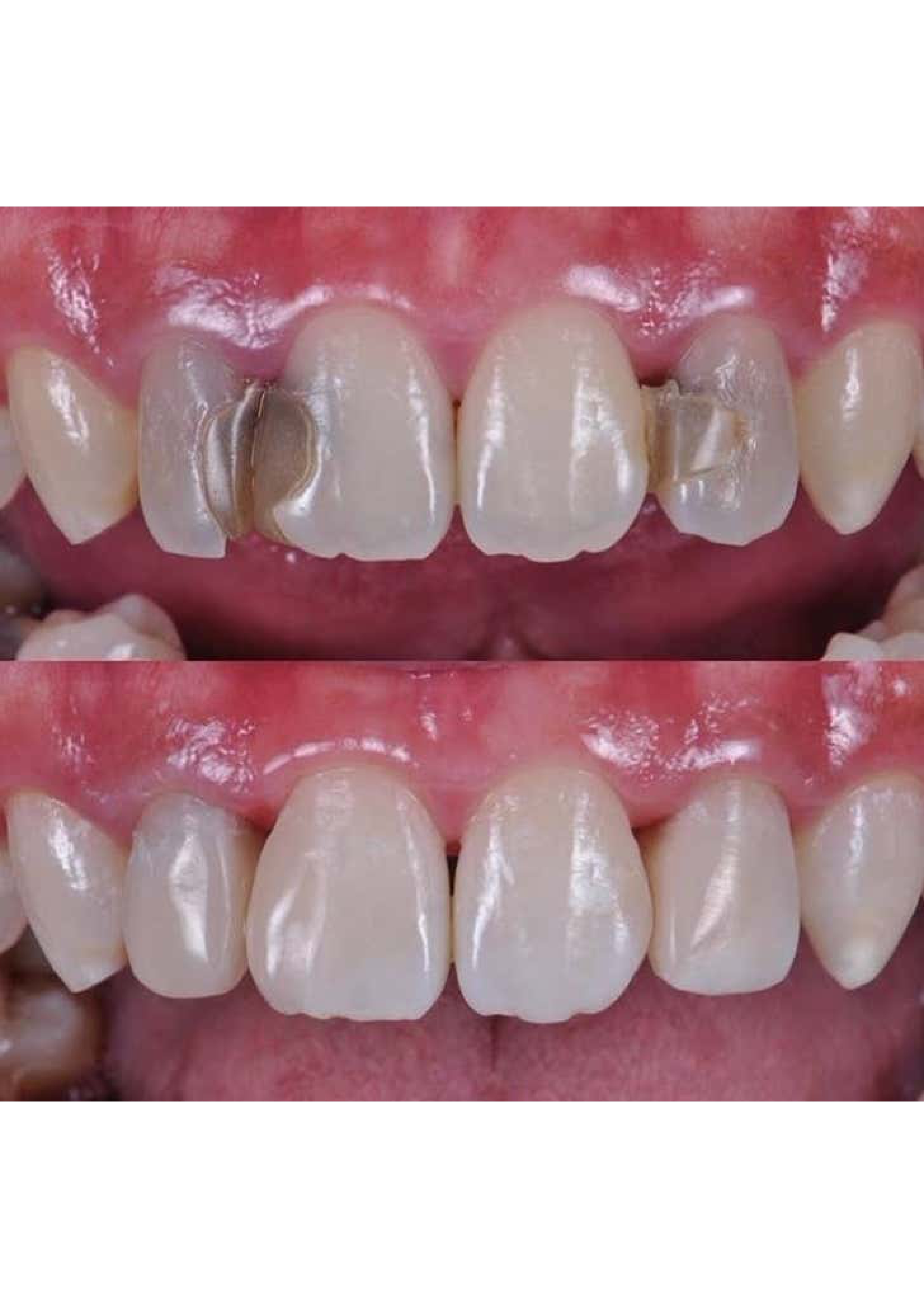 Tooth-Colored Filling 5
