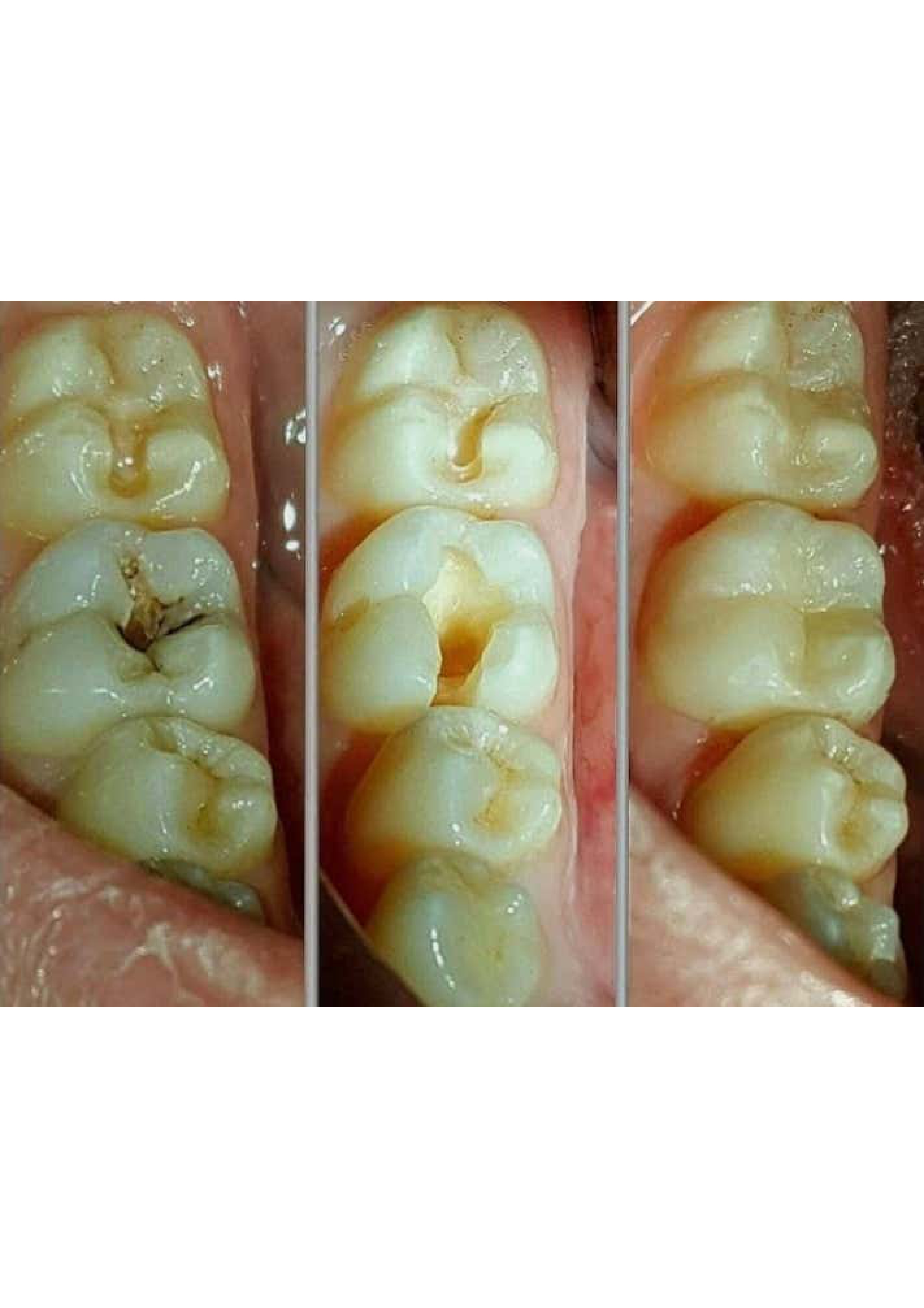 Tooth-Colored Filling 6