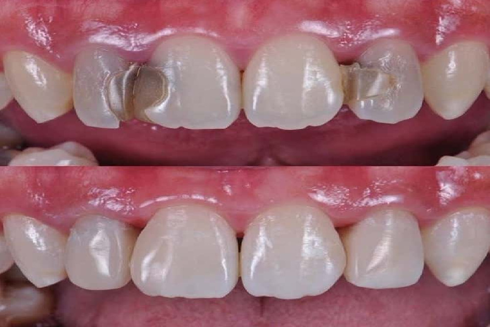 Tooth-Colored Fillings