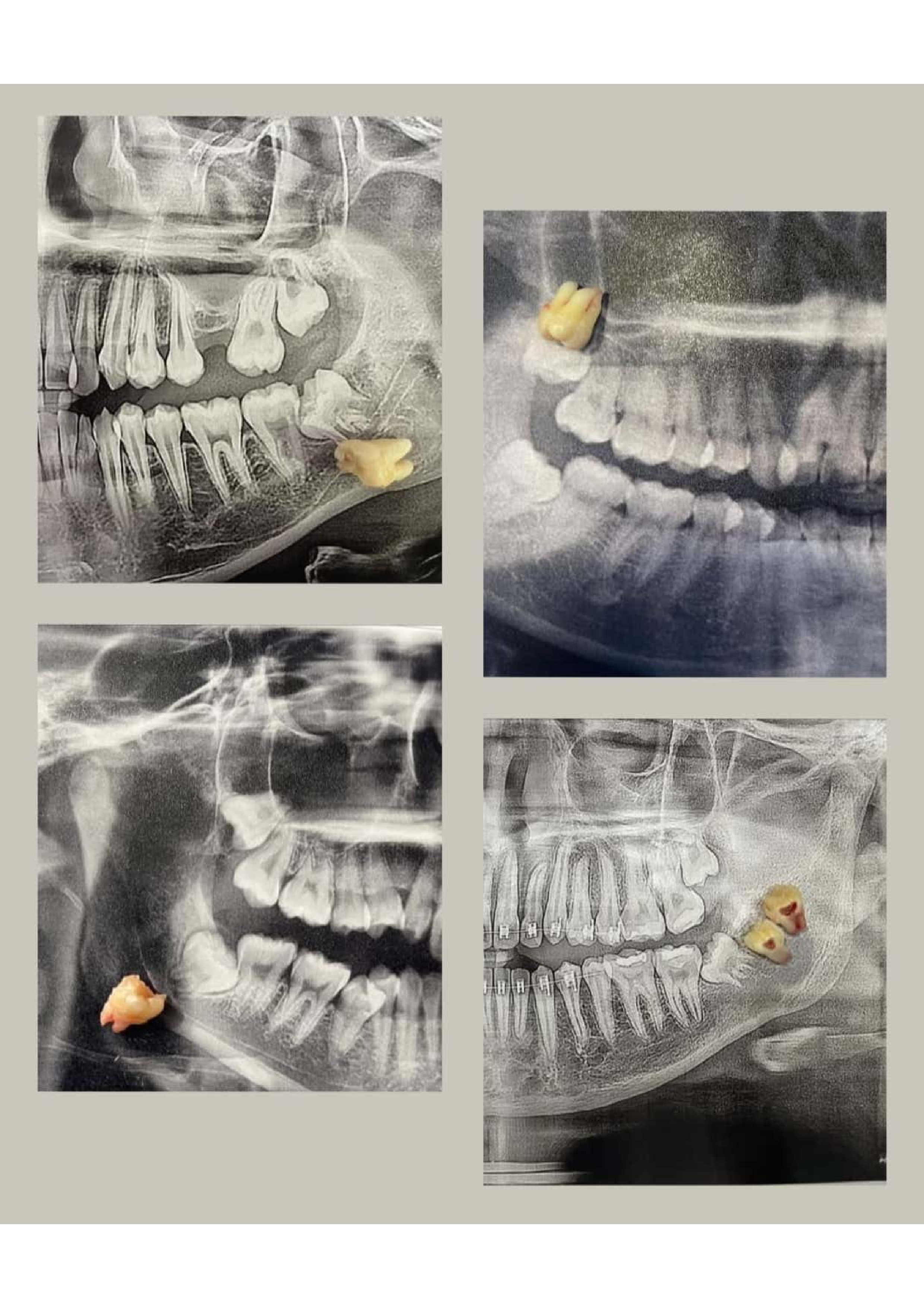 Wisdom Teeth 1