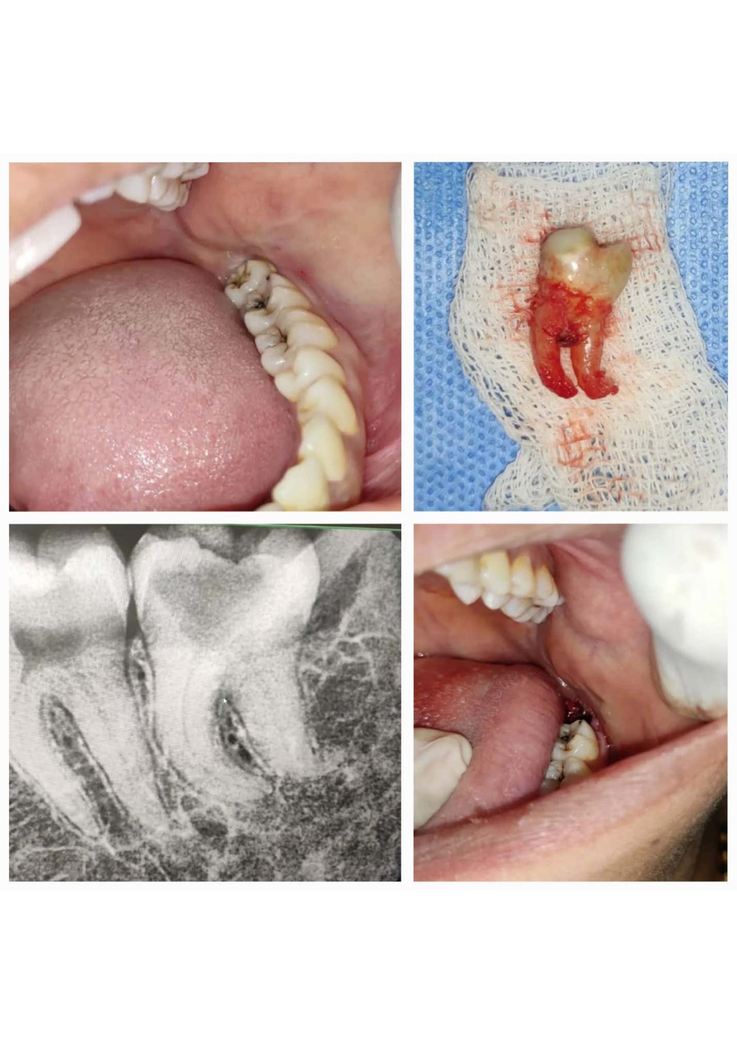 Wisdom Teeth 2