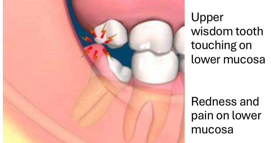 Wisdom Teeth 3