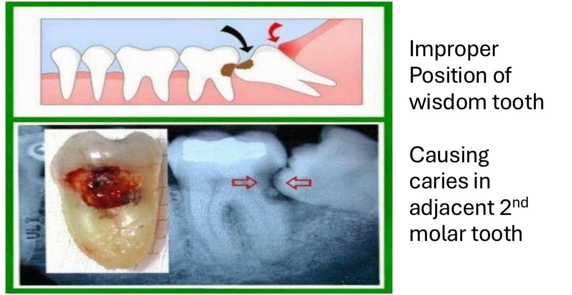 Wisdom Teeth 4