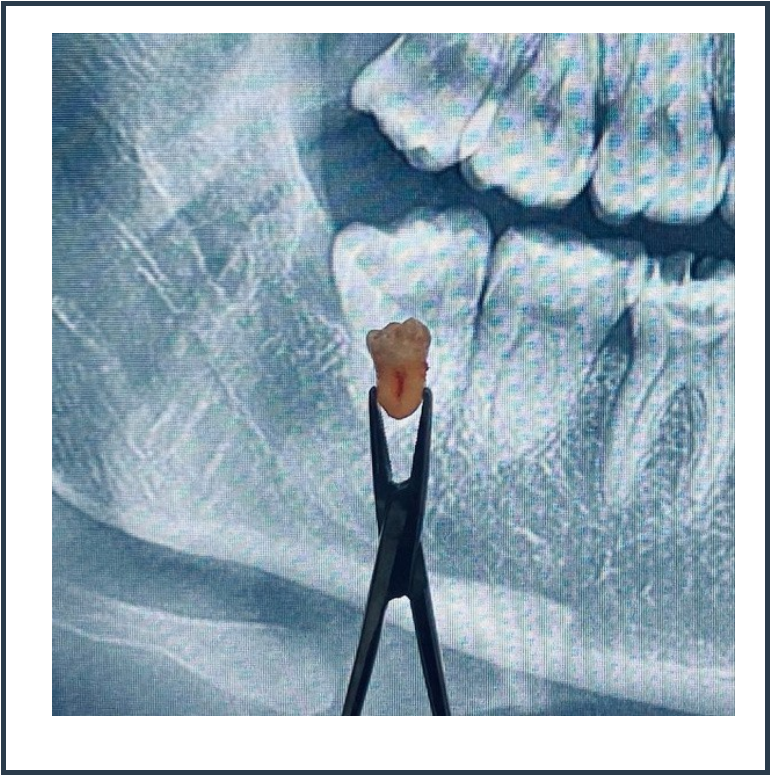 Extractions