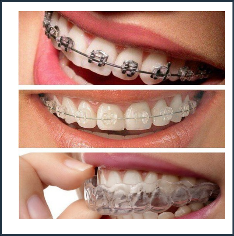 Orthodontic Treatment/Braces