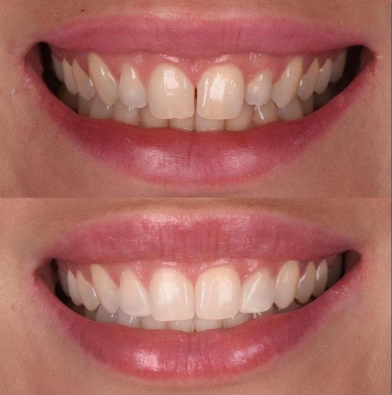 Smile Designing