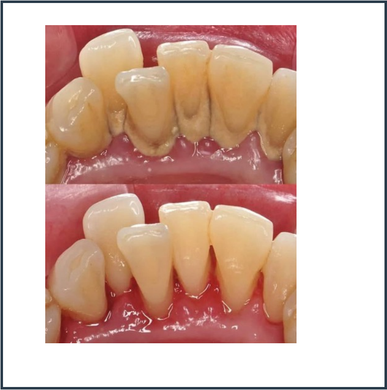 Teeth Cleanup