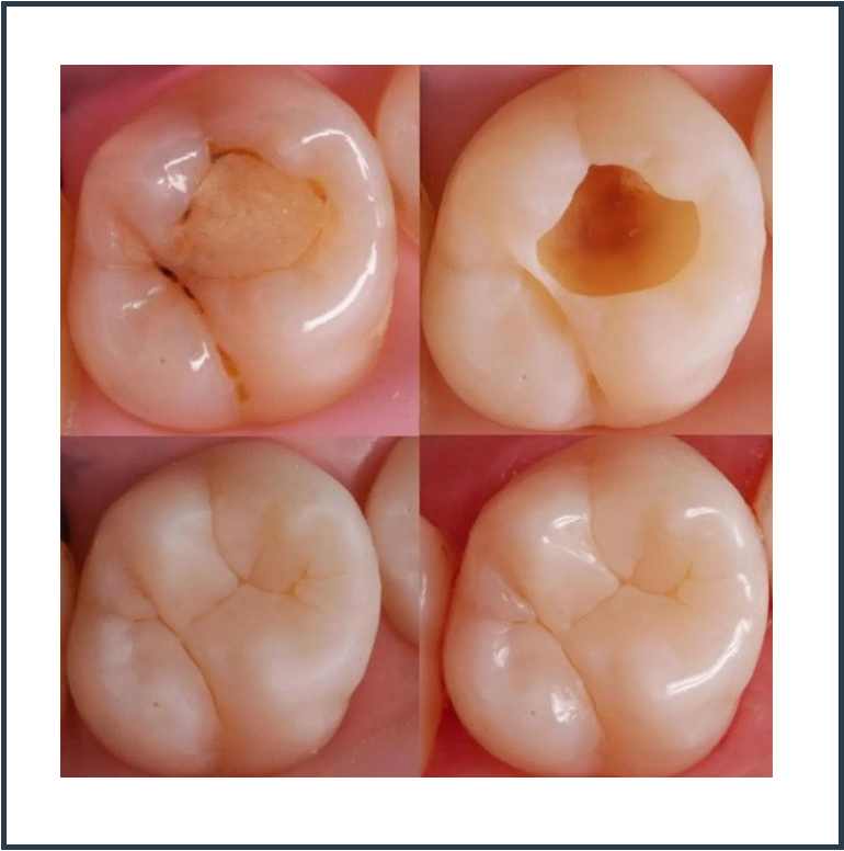 Filling and Restorations
