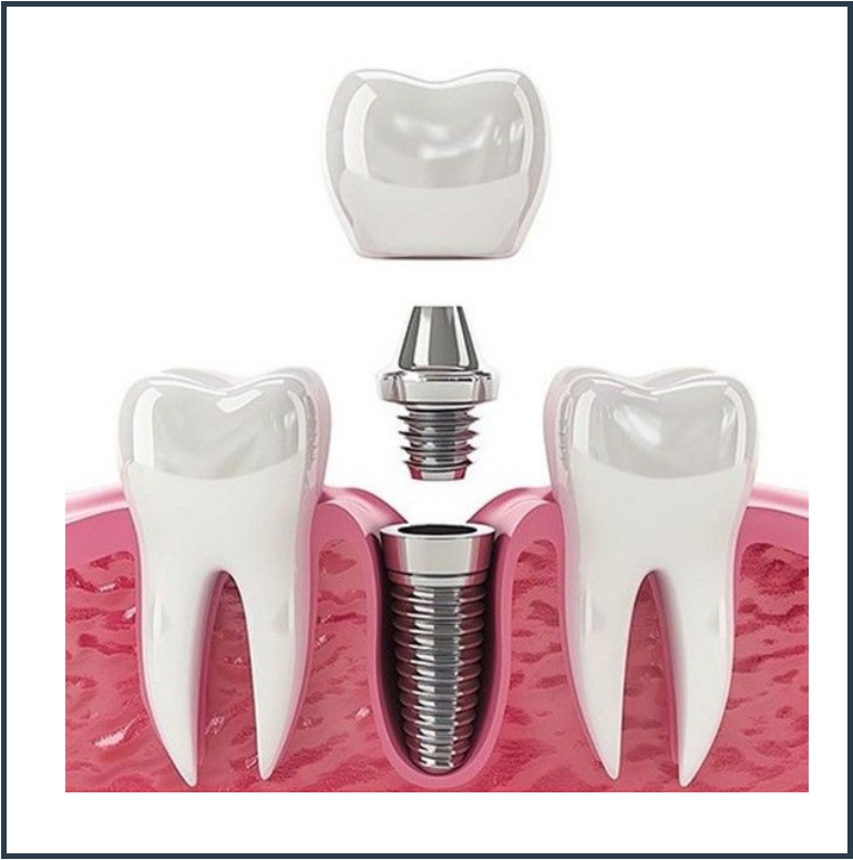 Dental Implants
