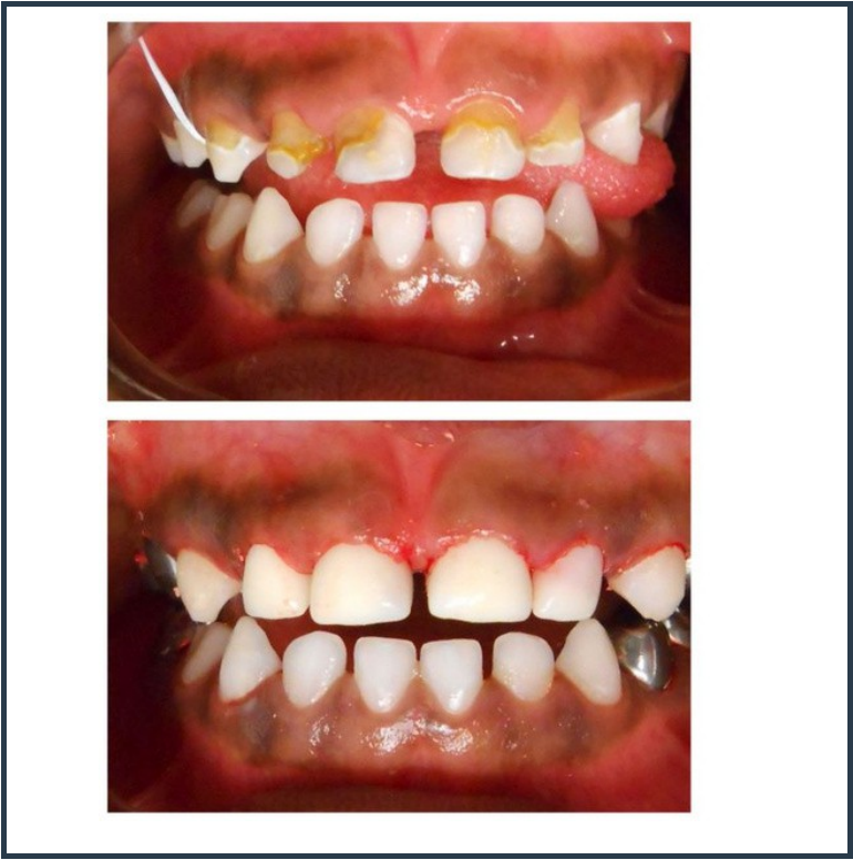Pediatric Dental Care